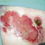 Figure 6. Dermite péri-stomiale à type de pyoderma gangrenosum.