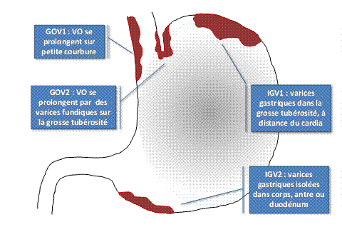 Différents types de varices gastriques