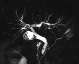 Patient exploré par bili-IRM pour une suspicion de migration lithiasique