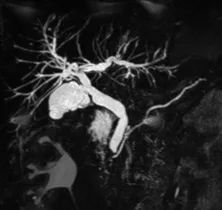 Patient exploré par bili-IRM pour une suspicion de migration lithiasique