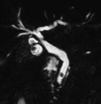 Patient exploré par bili-IRM pour une suspicion de migration lithiasique