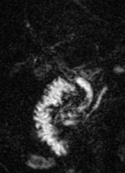 Acquisition 3D de bili-IRM. Chez ce patient à la respiration irrégulière, l’échec de la synchronisation respiratoire (nécessaire à l’acquisition de cette séquence) rend dans ce cas les images quasi ininterprétables.