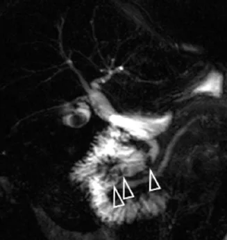 Coupe épaisse 2D acquise lors d’une courte année qui s’avère plus contributive pour montrer l’empierrement cholédocien