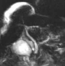 Coupes de bili-IRM 2D