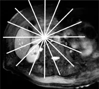 Recherche de calculs résiduels chez une patiente cholécystectomisée