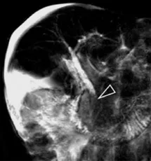 Sclérose hépato-portale avec ascite