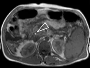 Sclérose hépato-portale avec ascite