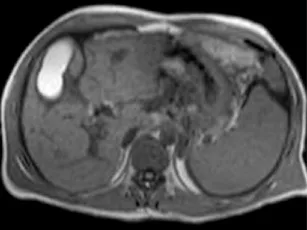 Sclérose hépato-portale avec ascite