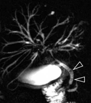 Empierrement cholédocien suspecté