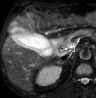 Bulles d’aérobilie