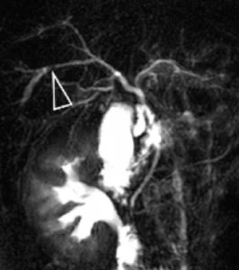 Lithiases intrahépatiques en bili-IRM