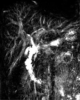 Intérêt du gadolinium pour l’exploration des cholangites sclérosantes primitives