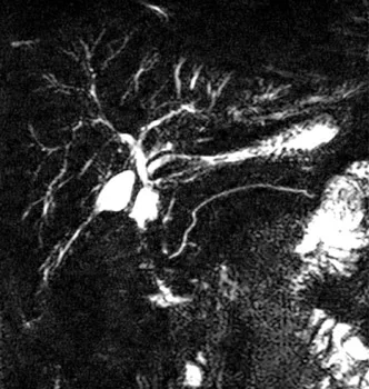 Intérêt du gadolinium pour l’exploration des cholangites sclérosantes primitives