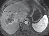 Métastases hépatiques d’un cancer du colon : Examen initial montrant que le grand axe de la lésion est de 81 mm.