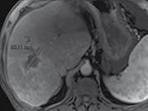 Métastases hépatiques d’un cancer du colon : Après quatre cycles de chimiothérapie, la lésion mesure 59 mm, soit une amélioration de 27 %.