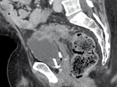 Métastases péritonéales d’un cancer du colon : Par contre, l’infiltration sus-vésicale est difficile à délimiter du tube digestive