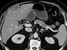 Cancer du colon avec métastases métachrones