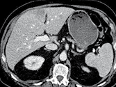 Cancer du colon avec métastases métachrones