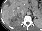 Carcinome hépatocellulaire