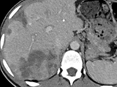 Carcinome hépatocellulaire