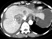 Métastases hépatiques d’un cancer du colon : Examen initial