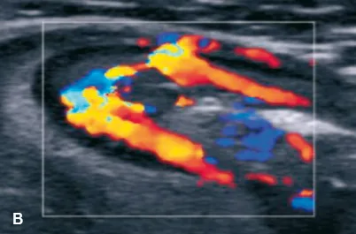  Échographie Doppler en coupe longitudinale montrant une hypervascularisation de la paroi digestive