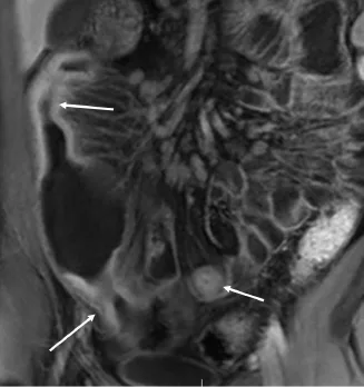 Patient de 32 ans ayant une maladie de Crohn connue. Séquence d’entéro-IRM en pondération T1 après injection de gadolinium dans le plan coronal montrant une atteinte multifocale de l’iléon avec sténoses et dilatations présténotiques entre les atteintes successives