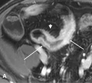 Séquence en pondération T1 après injection de gadolinium dans le plan axial montrant l’épaississement et la prise de contraste marquée avec aspect en cocarde de la paroi (flèches) ;