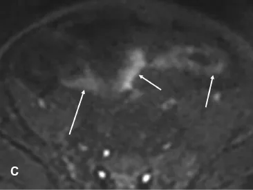 Séquence en diffusion à b élevé montrant un hypersignal de la paroi de l’anse pathologique traduisant une restriction de la diffusion