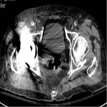 Comparaison de la même image reconstruite par rétroprojection filtrée