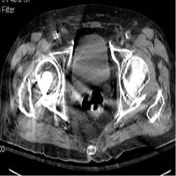 Comparaison de la même image reconstruite par rétroprojection filtrée