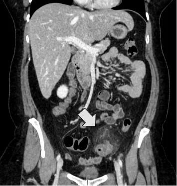 Reconstruction coronale de 2 images acquises chez le même patient atteint d’une sigmoïdite diverticulaire