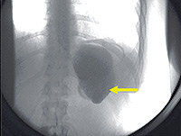 Horizontalisation de l’anneau (slippage) avec dilatation de poche en amont