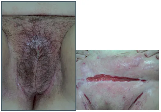 Figure 1. Ulcérations génitales et cutanées spécifiques en « coup de couteau »