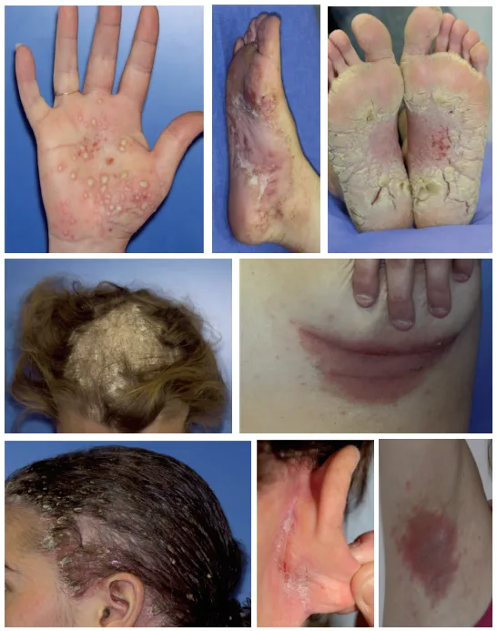 Figure 7. Eruptions psoriasiformes sous anti-TNFa