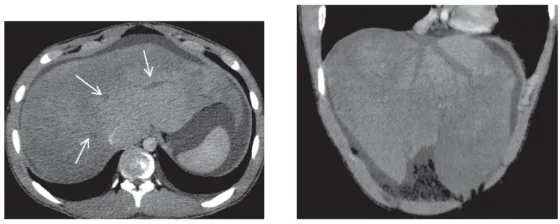 Figure 3. Syndrome de Budd Chiari à la phase aiguë – foie congestif, augmenté de volume. Les 3 veines sus-hépatiques sont thrombosées simultanément. Sur la reconstruction coronale, on ne visualise que les veines moyenne et gauche (collection Pr Otal, Radiologie CHU Rangueil Toulouse)