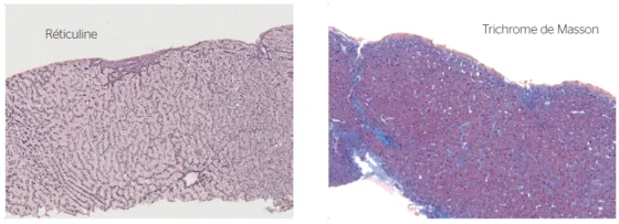 Figure 4. Hyperplasie nodulaire régénérative avec une fibrose portale faible, des images focales de fibrose des veines centro lodulaire et une nodulation hépatocytaire (collection Pr Selves, anatomopathologie CHU Toulouse)