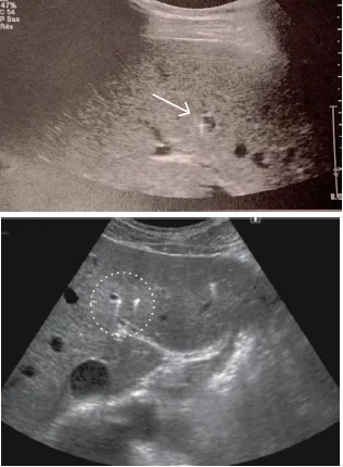 Figure 2. Spots hyper-échogène intra-hépatiques responsables d’images en queue de comète