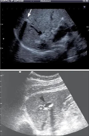 Lithiase intra-hépatique avec cône d’ombre (flèches)