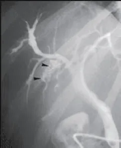 Figure 5. Dilatation sacculaire des voies biliaires intra-hépatiques autour de macro-calculs sans sténose biliaire sous-jacente (têtes de flèche)