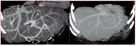Figure 2. Circulation collatérale inter sushépatique au TDM