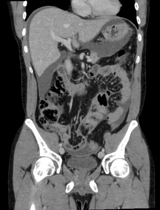 Figure 2. Foie de contours réguliers avec un macro-nodule d’hyperplasie nodulaire régénérative (collection Pr Otal, Radiologie CHU Rangueil Toulouse)