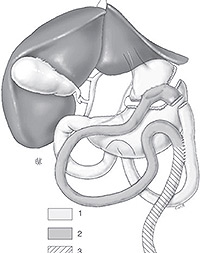 Bypass gastrique (document issu de l’EMC)