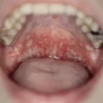 Figure 4. Pyostomatite végétante