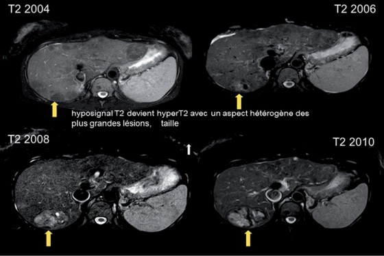 Figure 4. Modifications d’un nodule au cours du temps IRM en T2-évolution vers un CHC