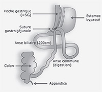 Minibypass