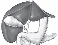 Sleeve gastrectomy (document issu de l’EMC)