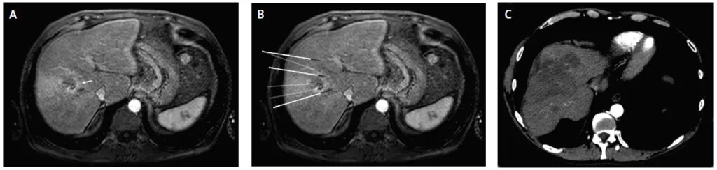 Figure 2. Ablation radiofréquence multibipolaire d’un CHC infiltrant du foie droit s’accompagnant d’une invasion postale Vp2