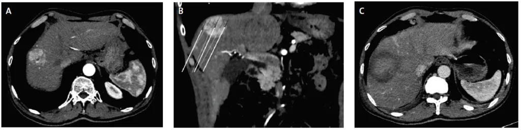 Figure 3. Ablation radiofréquence multibipolaire d’un volumineux CHC de 5,5 cm (mass forming) du dôme hépatique