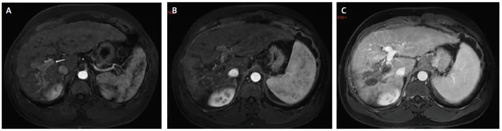 Figure 4. Ablation par electroporation irréversible d’un CHC infiltrant du foie droit avec envahissement portale Vp3
